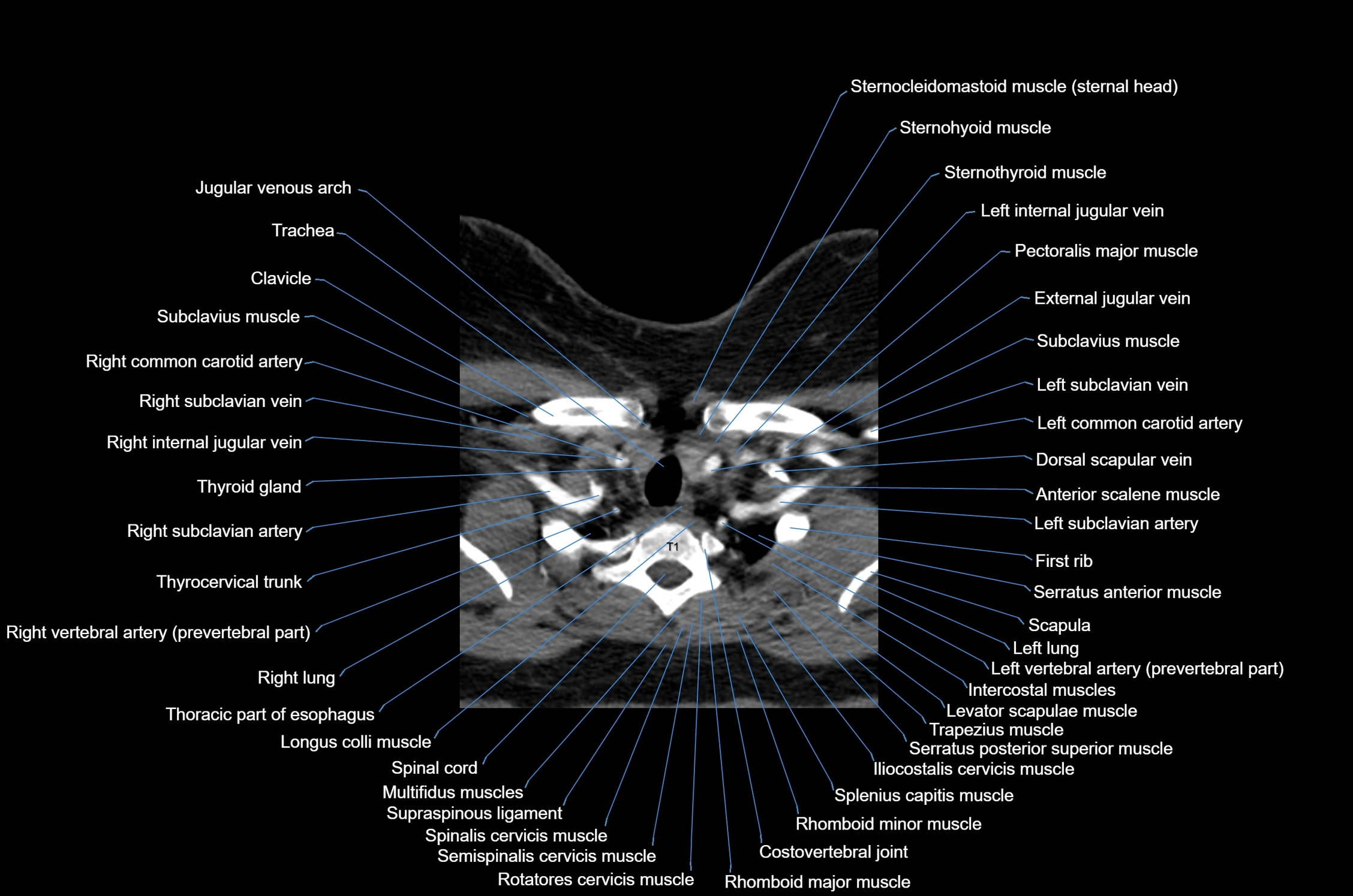 CT Neck axial cross sectional anatomy radiology image-img-00001-00054.webp